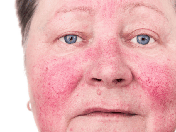 A woman with rosacea.