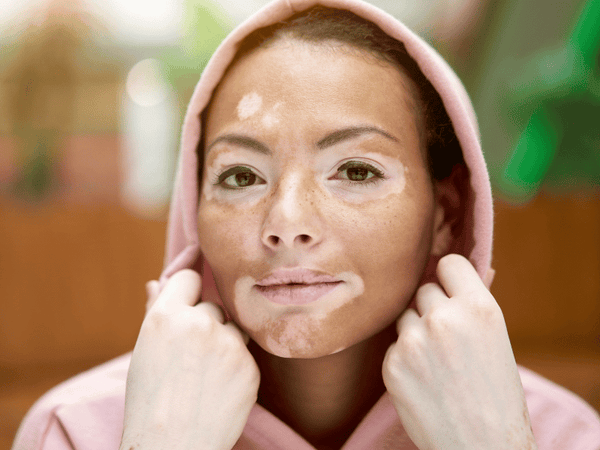 A woman wearing a pink hoodie who suffers vitiligo on her face.