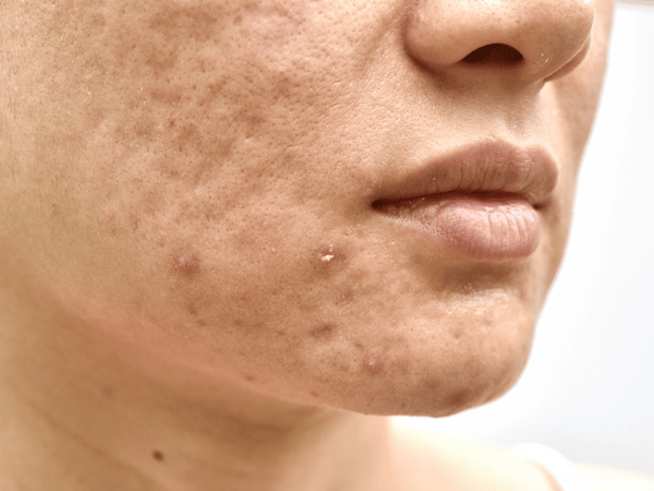An image of a woman with acne scars.