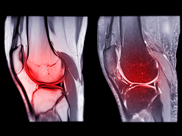 an x-ray image of ligament tears (ACL, MCL)