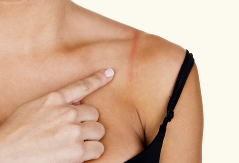 Woman with red shoulder marks from a bra