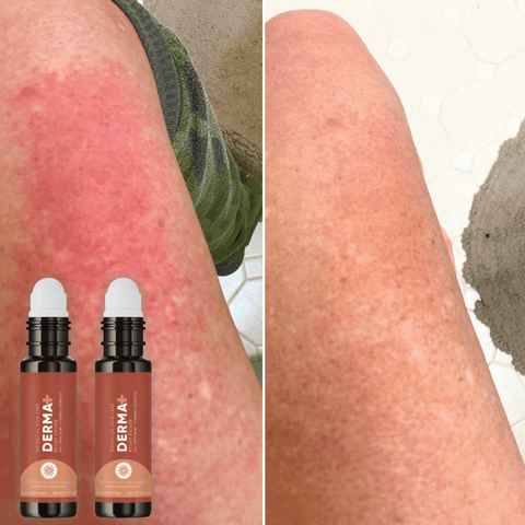 eczema before and after