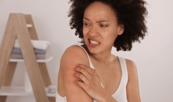 what is eczema