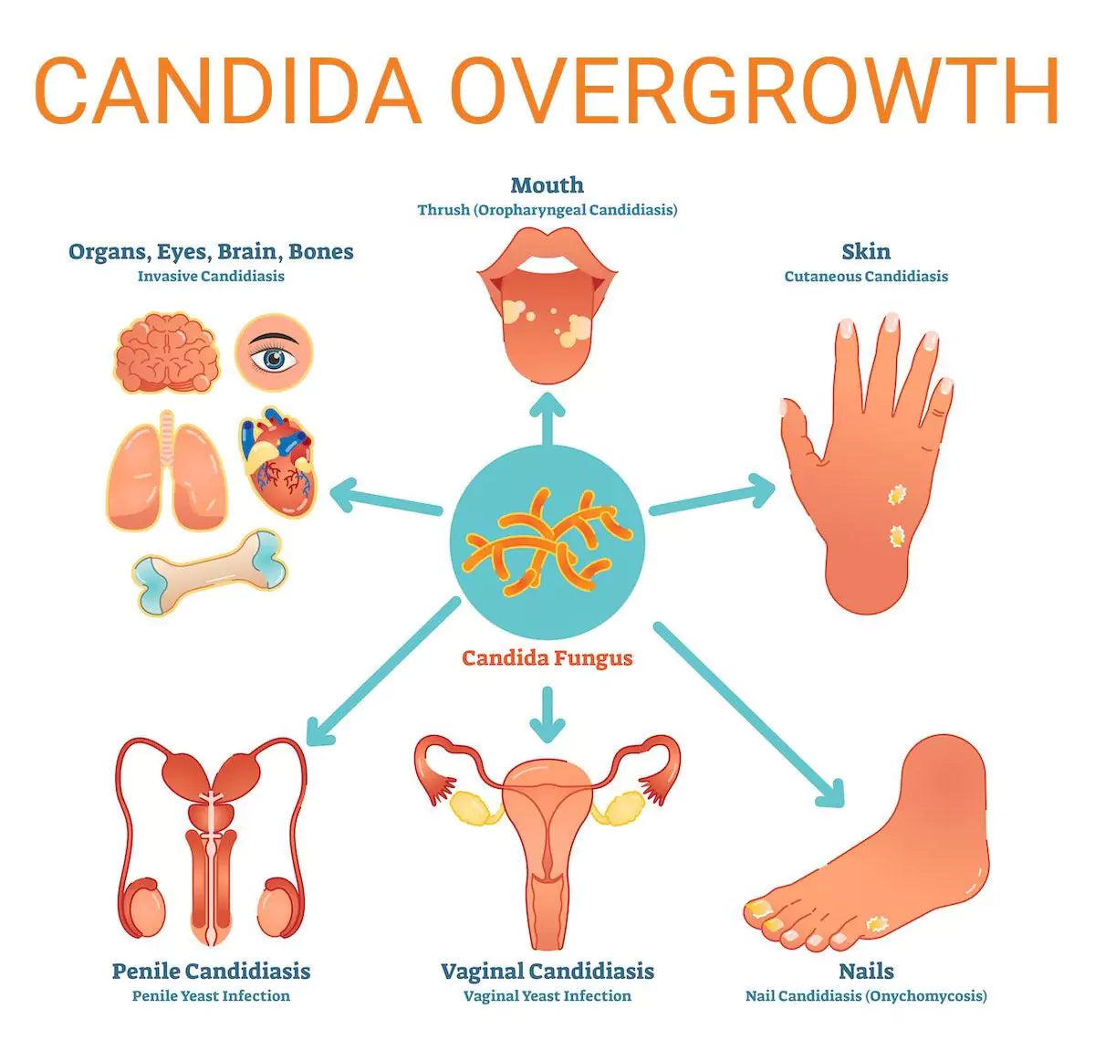 The impact of Candida overgrowth