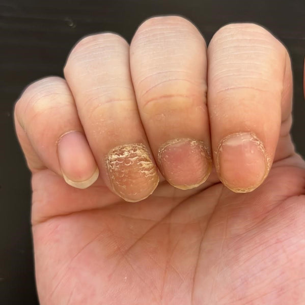 指甲凹陷 指甲橫紋所造成的凹陷不平