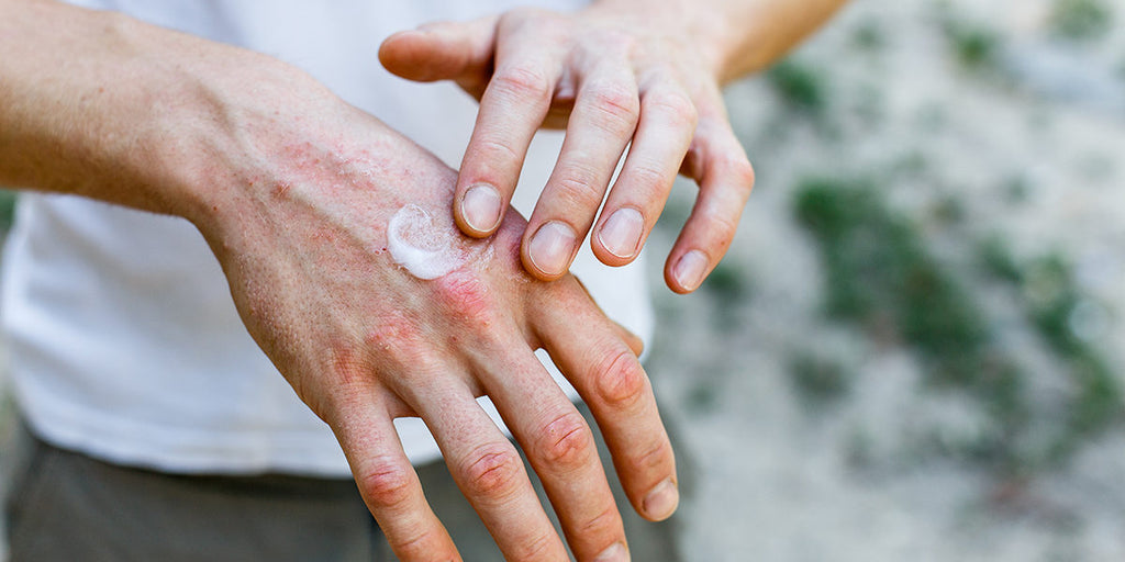 濕疹有哪些不同類型 手部濕疹 Hand eczema healthypig-magazine