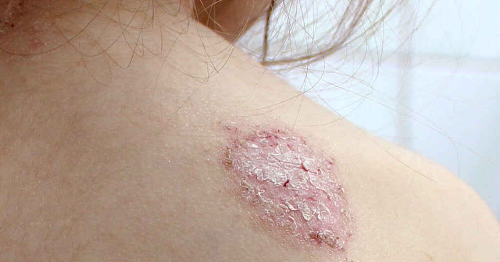 錢幣狀濕疹 Nummular eczema 濕疹有哪些不同類型