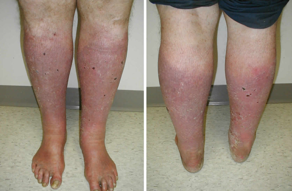 鬱積性皮膚炎 Stasis dermatitis 濕疹有哪些不同類型