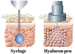 Syrynge Vs Hyaluron Pen