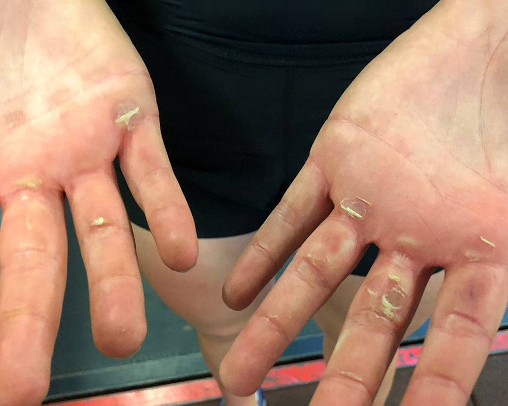 Blisters on Hands After Rowing