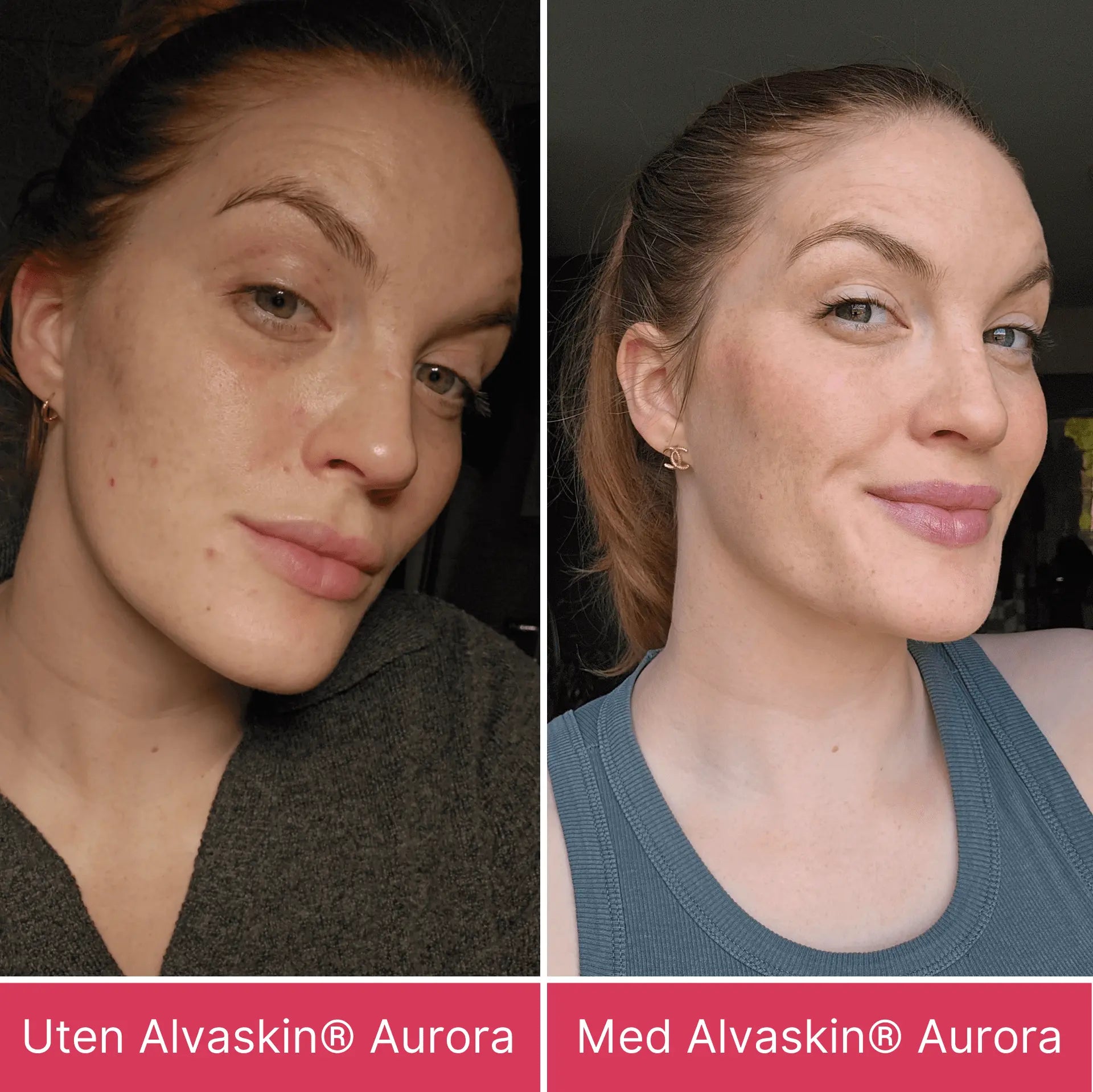 Side-by-side comparison of a woman before and after using Alvaskin® Aurora.