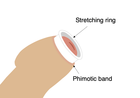 Phimosis : Causes and factors that lead to tight foreskin – Phimostretch