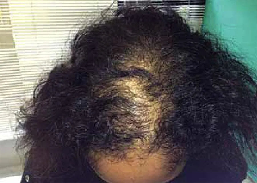 Androgenetic alopecia