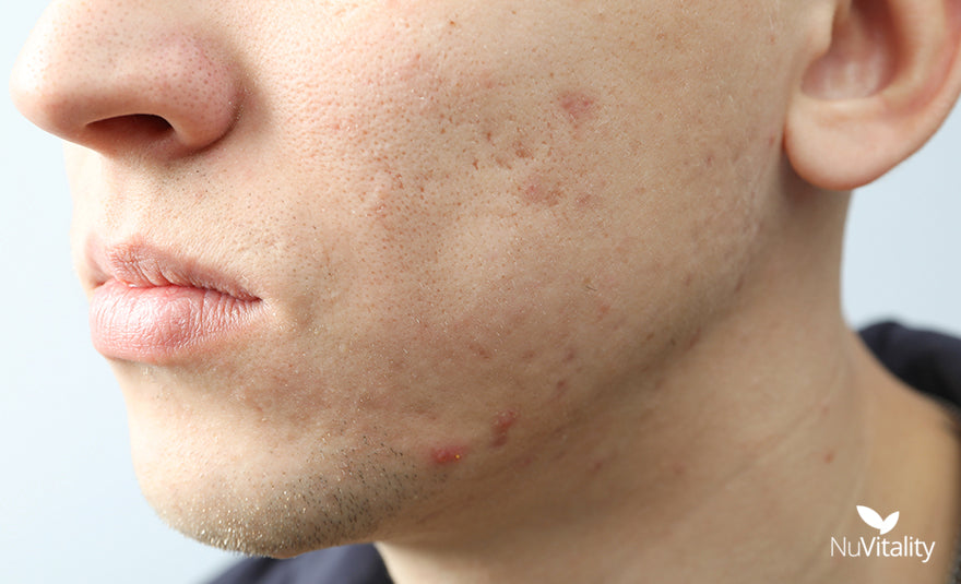 Face Acne Scarring