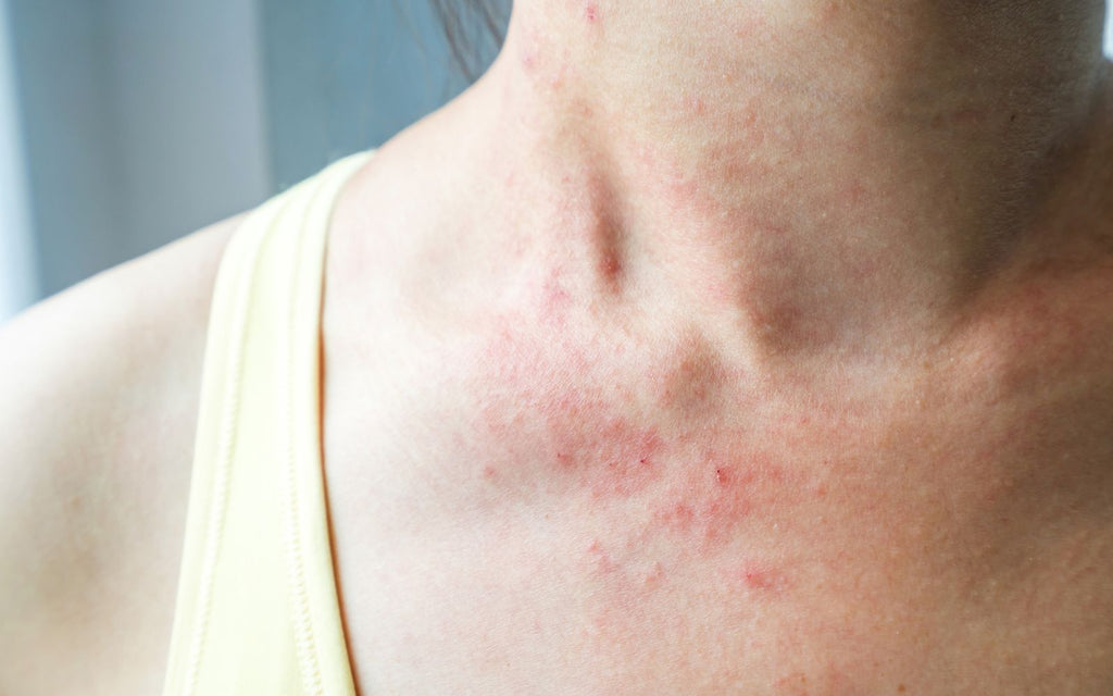 How To Fight Eczema  12 DermatologistTested Products for Eczema