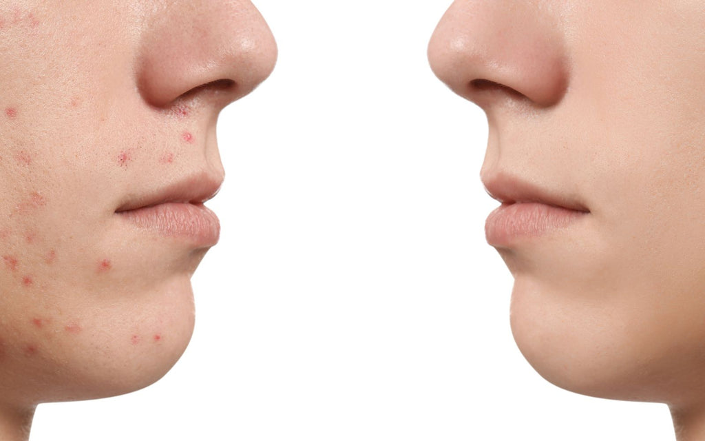 Before and after photos show that microdermabrasion can significantly improve the overall appearance of the skin.