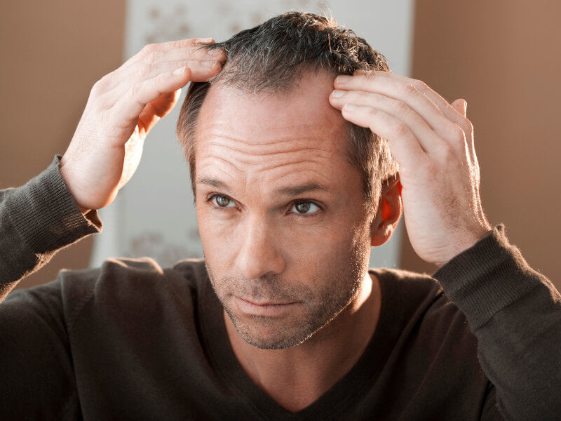 Man losing his hair