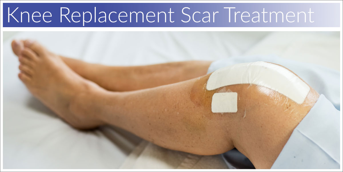 Knee replacement scar treatment