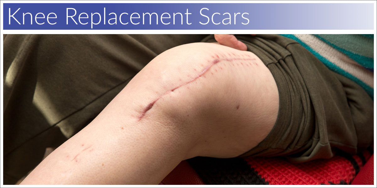 Knee replacement scar treatment
