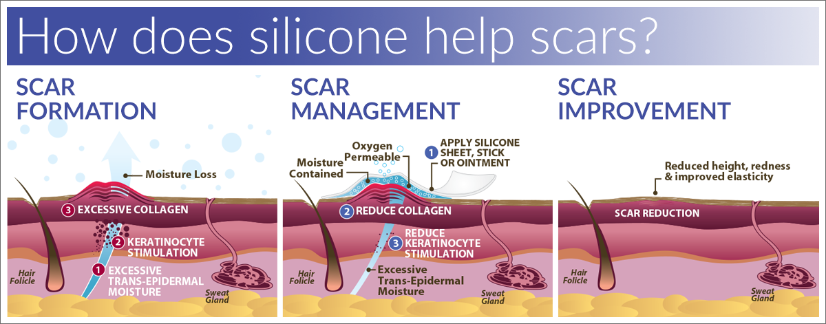 Silicone for scars