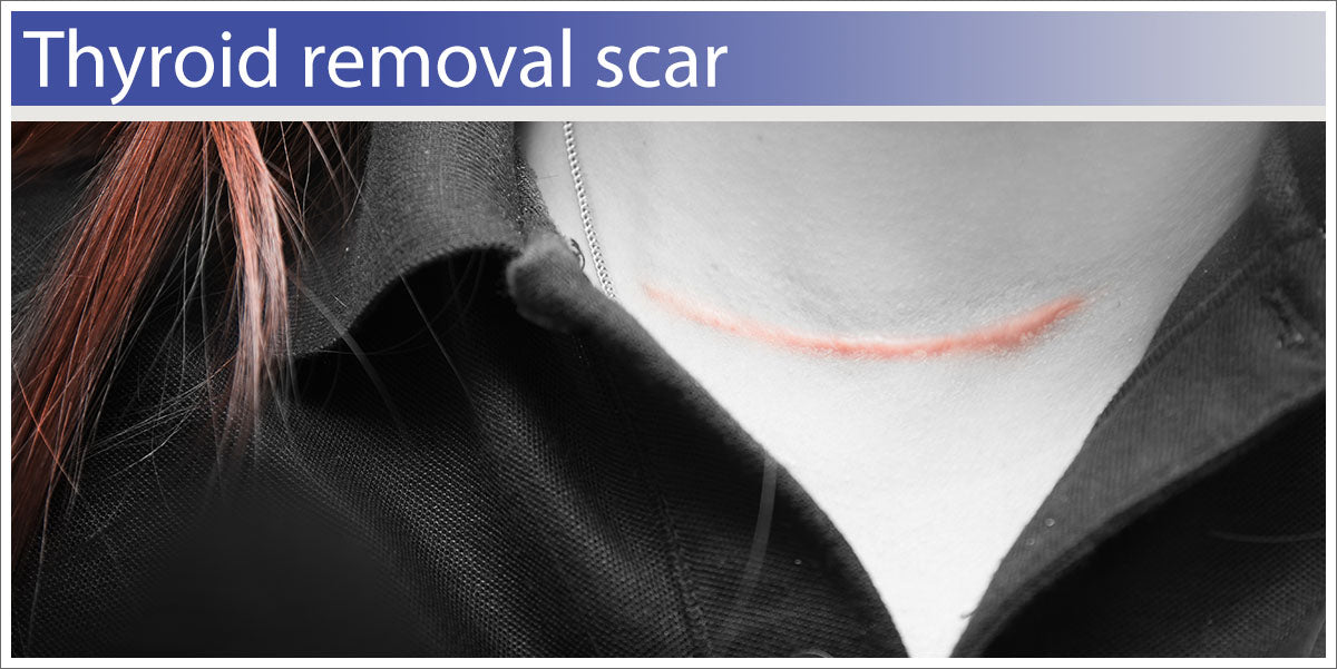 Thyroid surgery scar