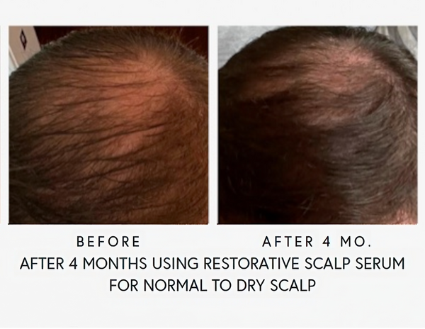 After 4 Months Using Restorative Scalp Serum For Normal to Dry Scalp