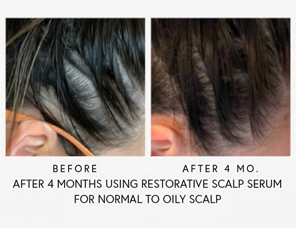 After 4 Months Using Restorative Scalp Serum For Normal To Oily Scalp