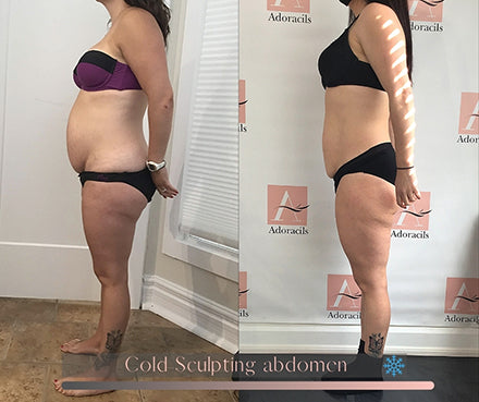 Résultat de Coolsculpting chez Adoracils