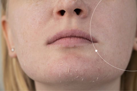 Dry Skin and Eczema on Chin 