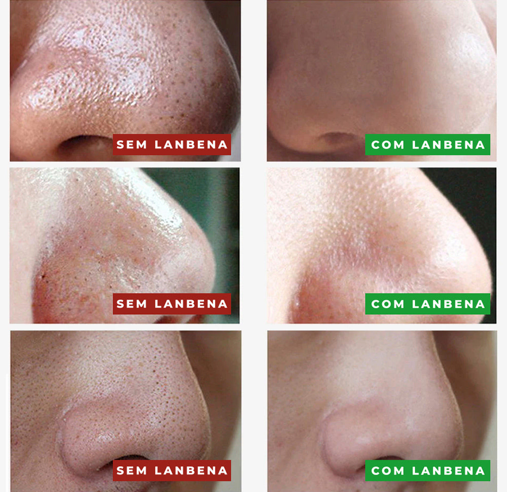 Máscara Removedora de Cravos LANBENA - Limpeza Profunda e Tratamento para Acne