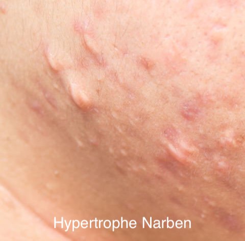 Hypertrophe Narben