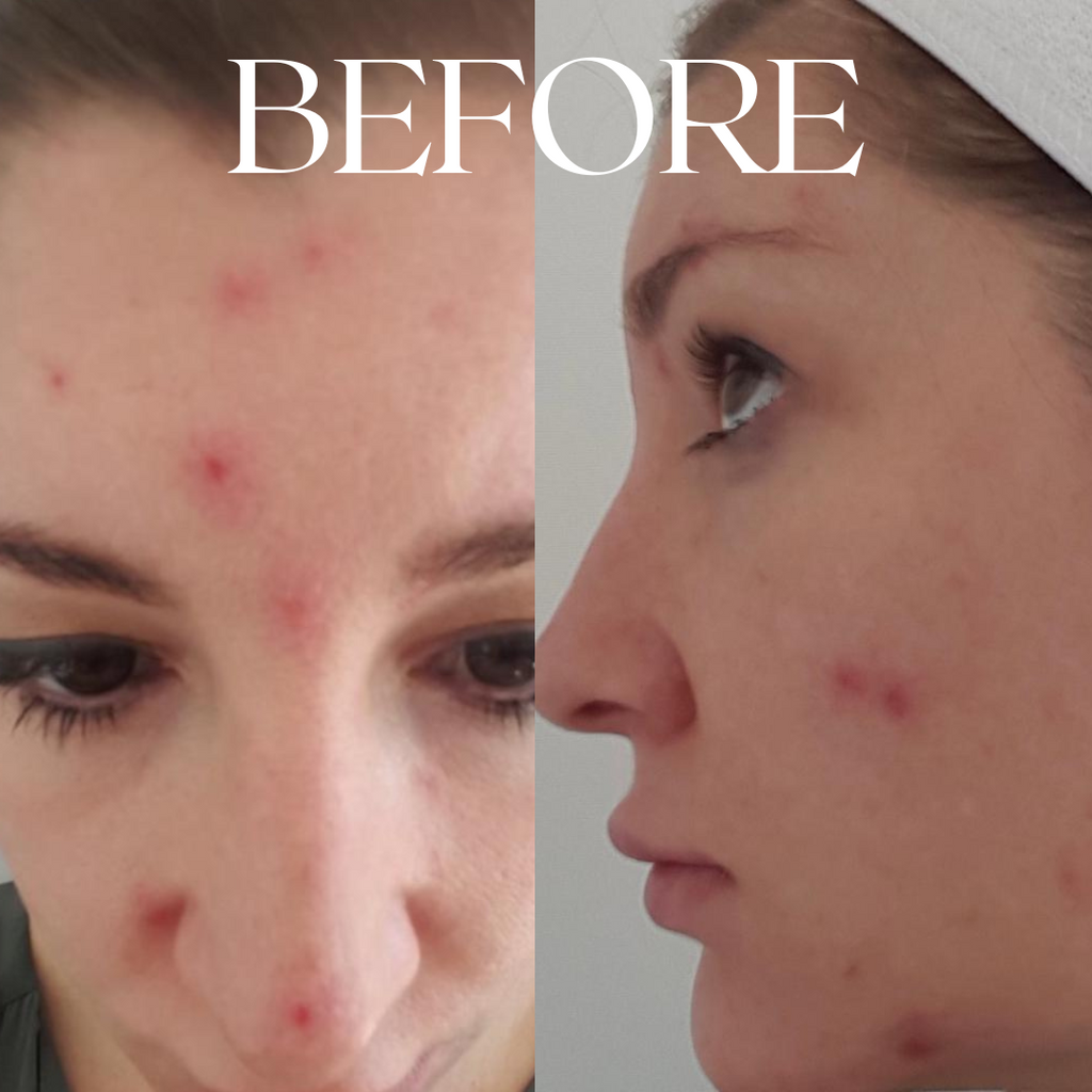 Acne skin breakout on women's face