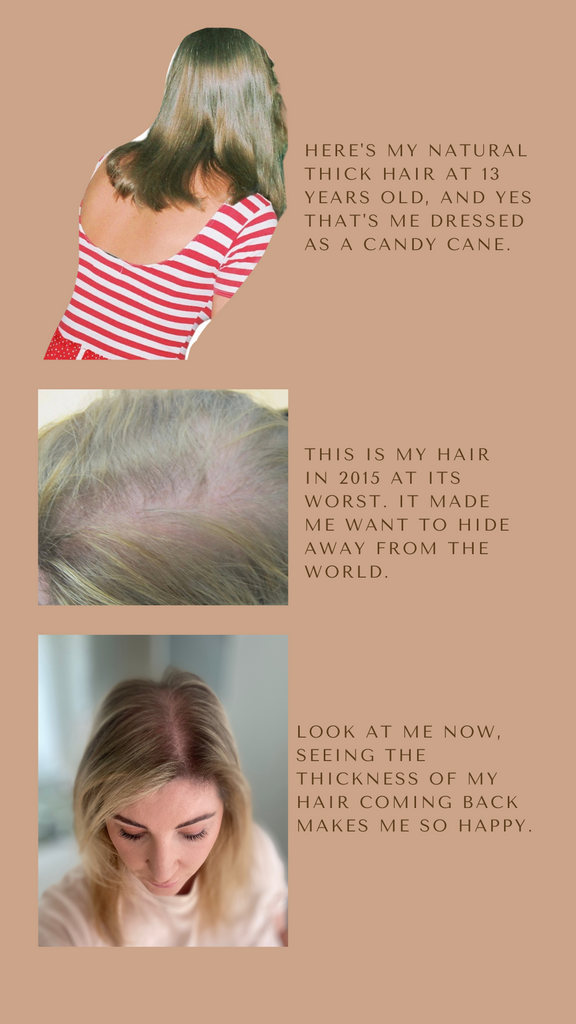 Before and after images of hair loss and now with regrowth of hair