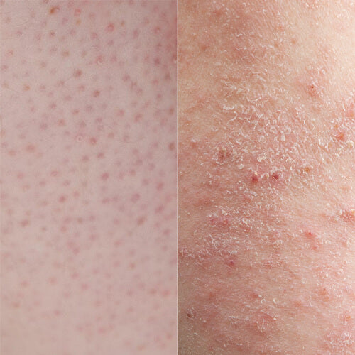 Keratosis Pilaris Vs Eczema How To Tell The Difference Slmd