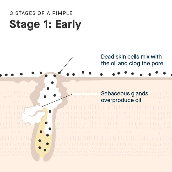 Early stages of a pimple before treatment