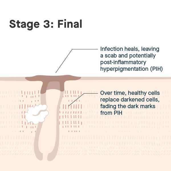 Final stages of a pimple