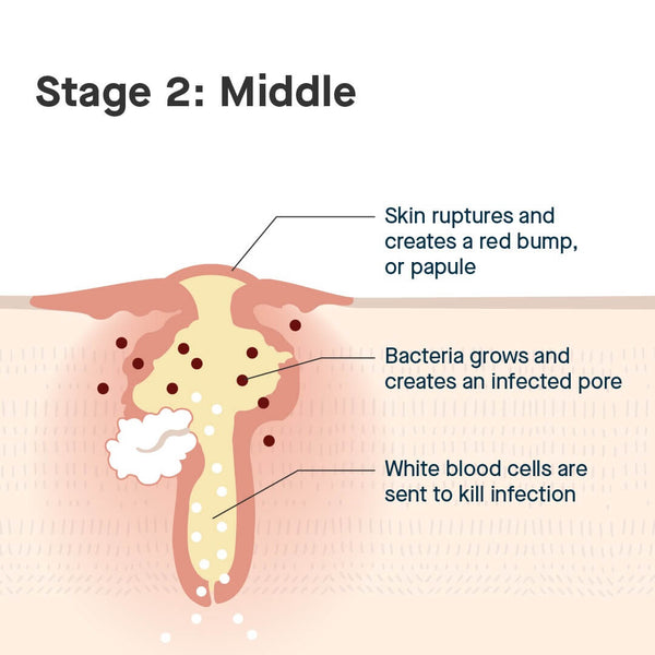 middle stages of a pimple