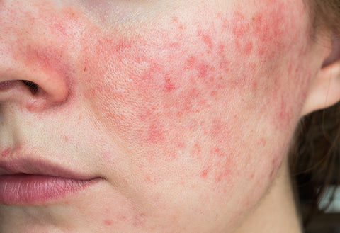 Rosacea causes clearance