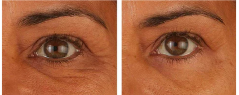 Anti-Wrinkles Micro-needle Under Eye Patch