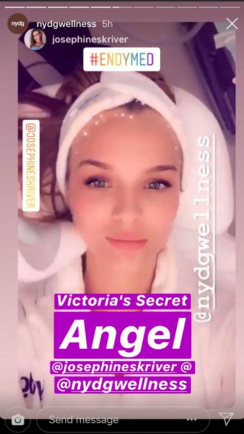 ENDYMED Victoria's Secret Angel