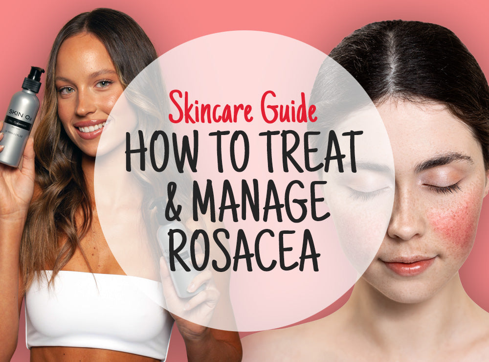 How to treat & manage Rosacea