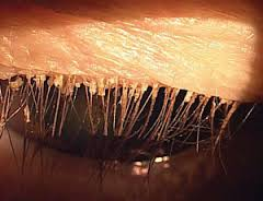 Demodex Mites on the Eye Lashes