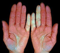 Acrocianosi e la sindrome di raynaud