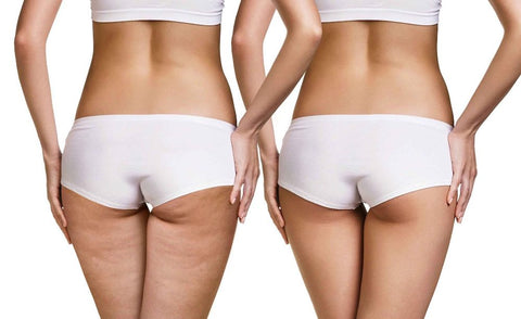 com eliminare la cellulite