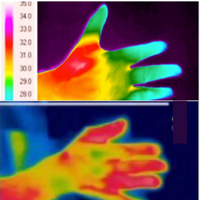 sindrome di raynaud immagini