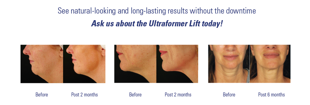 ultraformer skin lifting treatment