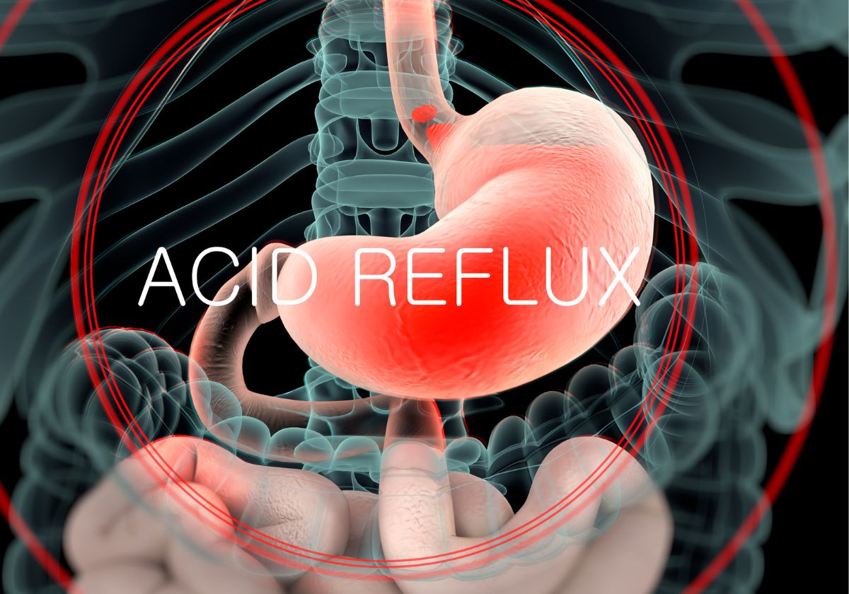 acid reflux