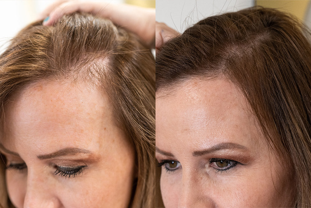 Forehead reduction  FUE hair transplant  Este Medical