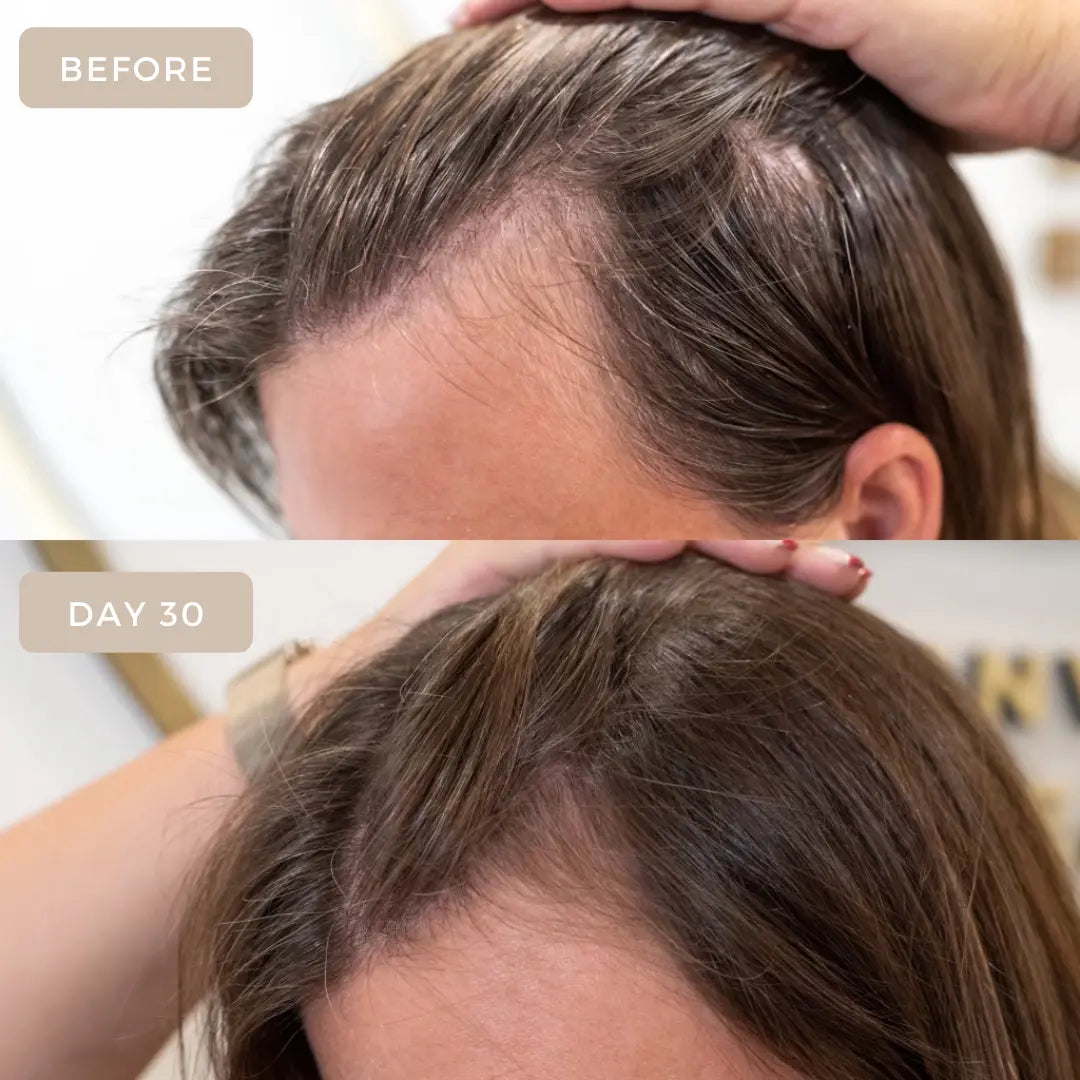 stress hair loss treatments