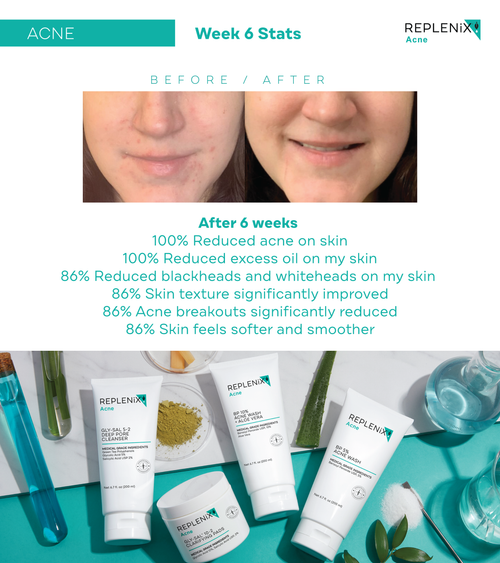 Before and after acne pictures skincare by Replenix